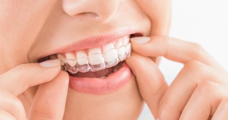 How Much Do Braces Cost In Canada? Straight Teeth isn't Cheap